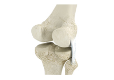 Posterolateral Corner (PLC) Reconstruction