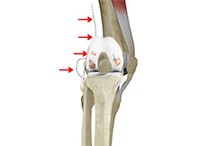 Posterolateral Instability