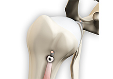 Proximal Biceps Tendinitis