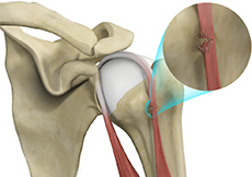 Proximal Biceps Tendon Rupture