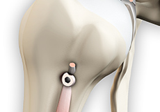 Proximal Biceps Tenodesis