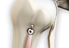 Proximal Humerus Fractures