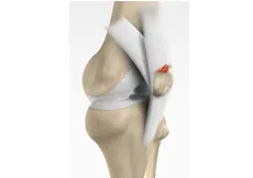 Quadriceps Tendon Rupture and Repair