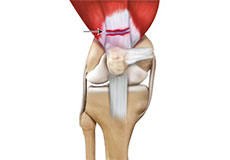 Quadriceps Tendon Rupture