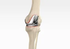 Revision Knee Ligament Reconstruction