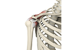 Rotator Cuff Bursitis