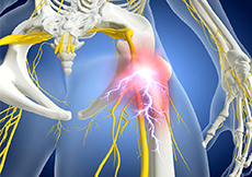 Sciatic Nerve Compression