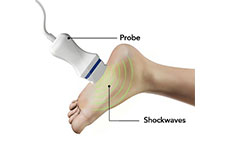 Shockwave Treatment for Plantar Fasciitis