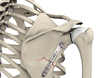 Shoulder Fracture Care