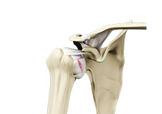 Shoulder Ligament Injuries