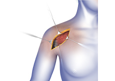 Shoulder Surgery