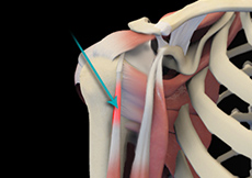 Shoulder Tendonitis