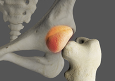 Slipped Capital Femoral Epiphysis