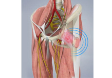 Snapping Hip Syndrome