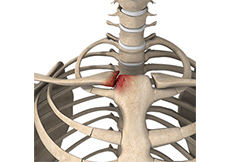 Sternoclavicular Arthritis