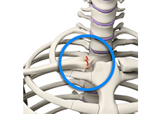 Sternoclavicular Separation