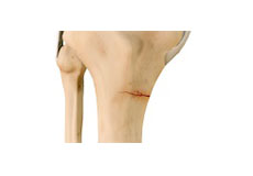 Stress Fracture of the Tibia