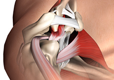 Shoulder Reconstruction Surgery