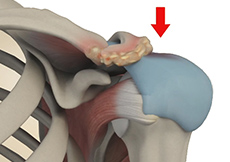 Subacromial Impingement Syndrome