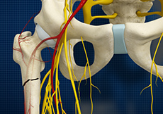 Subtrochanteric Hip Fracture