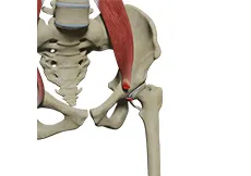 Surgical Release of Iliopsoas Tendon