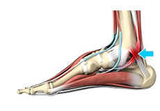 Tarsal Tunnel Syndrome