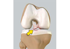Tibial Eminence Fractures