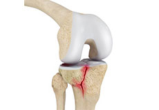Tibial Plateau Fracture