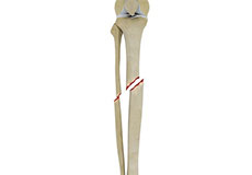 Tibial Shaft Fracture