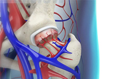 Transient Osteoporosis of the Hip