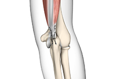 Triceps Repair