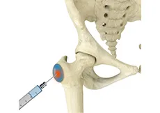 Trochanteric Bursa Injections