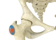 Trochanteric Bursitis