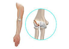 Upper and Lower Extremity Fracture Care