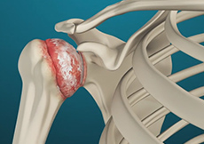 Viscosupplementation for Shoulder Arthritis