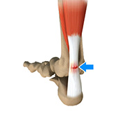 Achilles Tendon Rupture