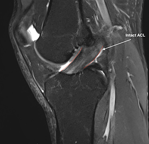 ACL Tears