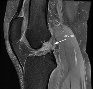 ACL Tears