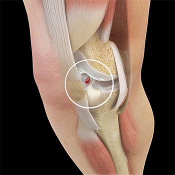 ACL Tears