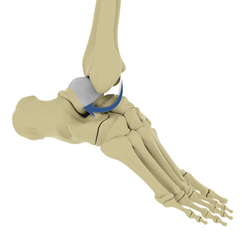 Ankle Dislocation