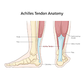 Achilles Tendon Rupture