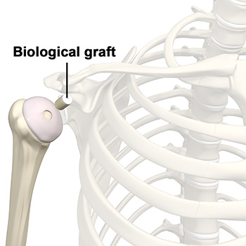 Biologic Shoulder Resurfacing