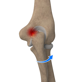 Elbow Impingement