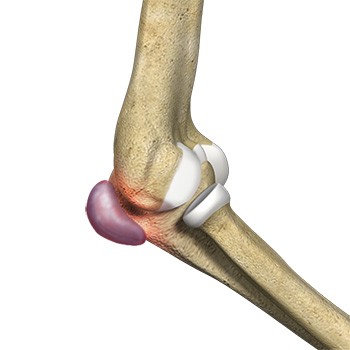 Elbow Trauma