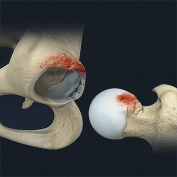 Femoroacetabular Impingement