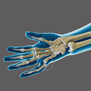 Finger Dislocation