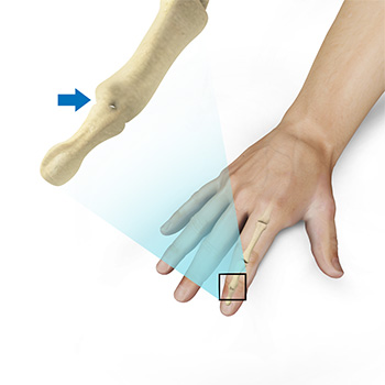 Finger Joint Fusion