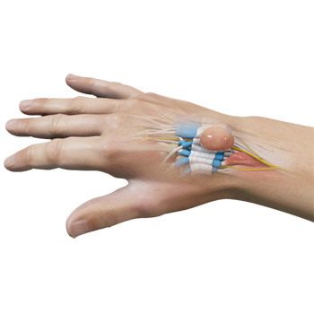 Ganglion Cyst