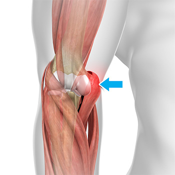 Golfer's Elbow