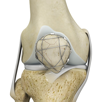 Knee Fracture Surgery